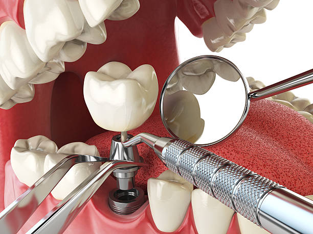 Best Emergency Dental Care for Broken or Chipped Teeth in Summit View, WA